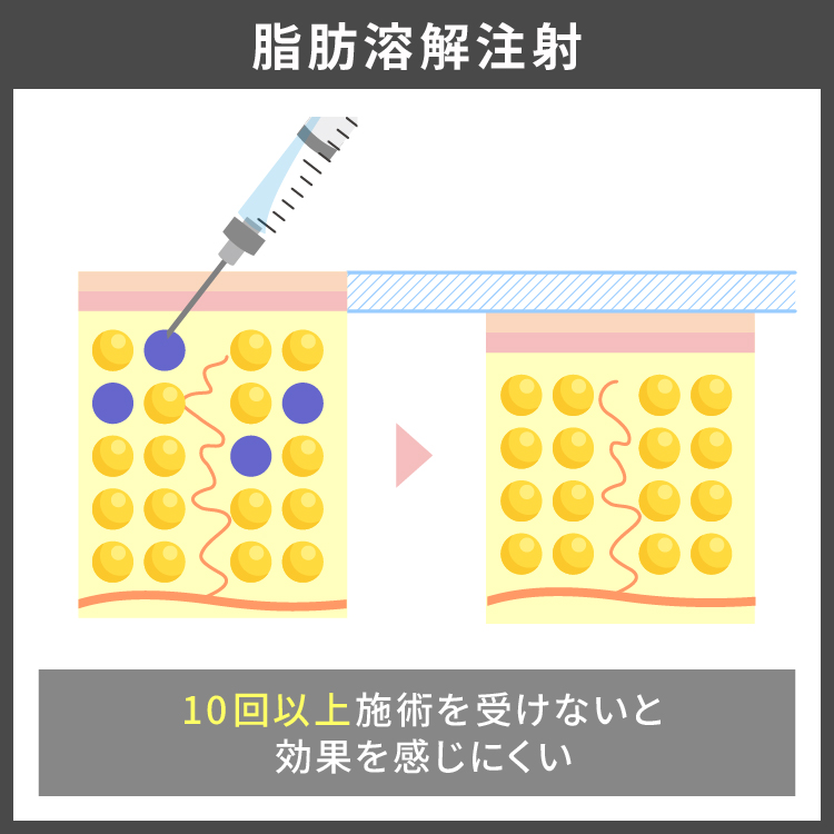 薬剤を注入することで脂肪減少を促進します。薬剤によっては10回以上の施術が必要な場合があります。