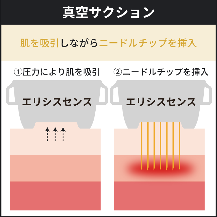 真空サクションに関する解説