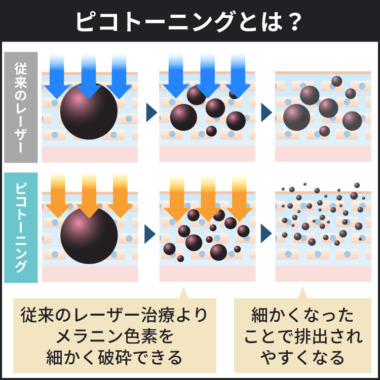 ピコトーニングは従来のレーザー治療よりもメラニン色素を細かくできるので体外に排出されやすくなりました